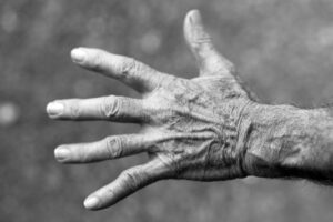 How Optimal Oral Health Can Protect You from Arthritis